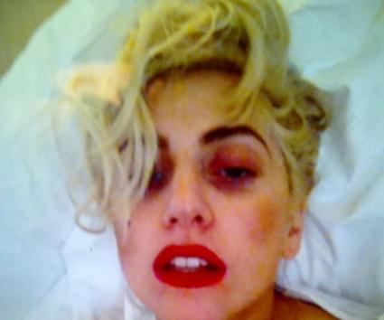 Η Lady Gaga ποστάρει φωτογραφία  με το μαυρισμένο μάτι της