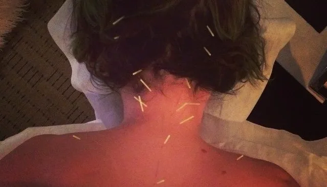 Η Katy Perry κάνει βελονισμό στον αυχένα και την πλάτη.