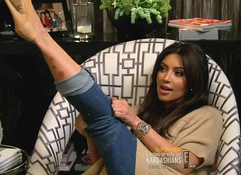 kim-kardashian-psoriasis
