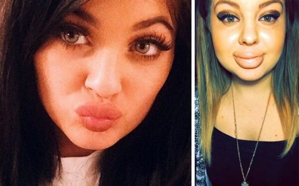 Κι όμως, τα χείλη της Kylie Jenner έστειλαν κόσμο στο νοσοκομείο! Διαβάστε πως