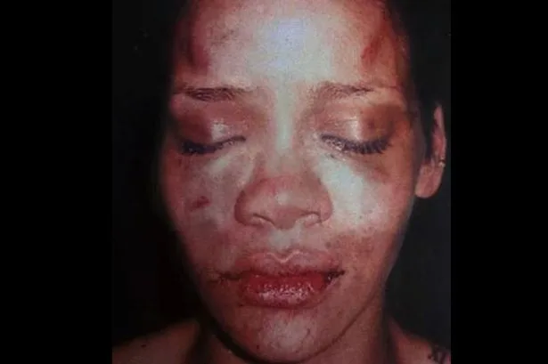 Rihanna-after-Chris-Brown-beat-her-in-2009