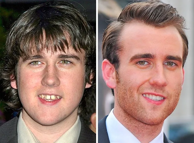 Κολάζ με φωτογραφίες πριν και μετά του Matthew Lewis που δείχνουν την αλλαγή στο χαμόγελό του.