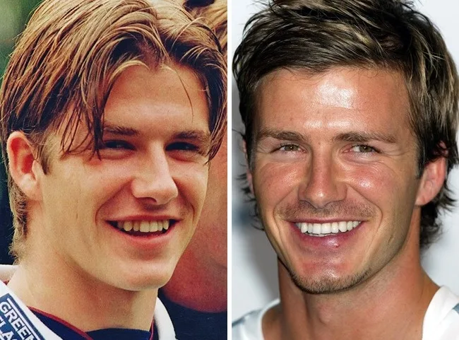 Ο David Beckham σε φωτογραφίες πριν και μετά την οδοντιατρική αισθητική επέμβαση.