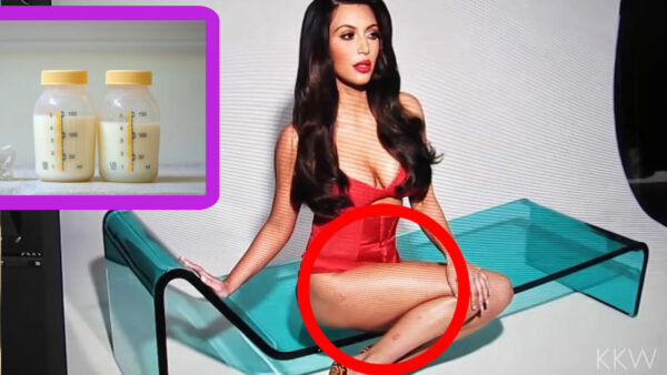 Οι περίεργες μέθοδοι με τις οποίες η Kim Kardashian προσπαθεί να αντιμετωπίσει την ψωρίαση