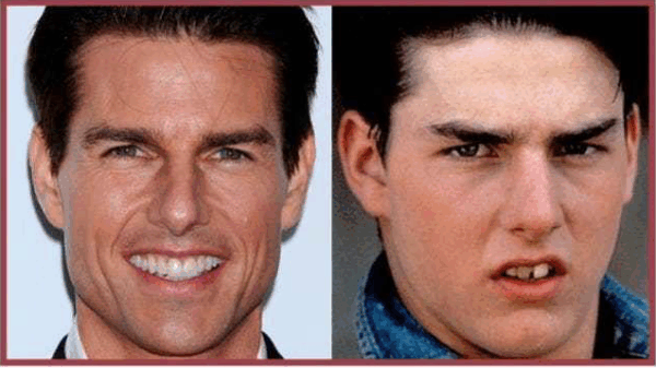 Before and After: Διάσημοι celebrities πριν αποκτήσουν το λαμπερό χαμόγελό τους