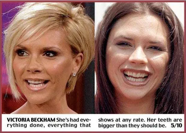 Κολάζ με δύο φωτογραφίες της Victoria Beckham που δείχνουν την αλλαγή στο χαμόγελο και την εμφάνισή της.