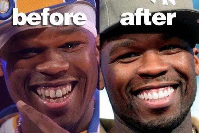 Κολάζ φωτογραφιών πριν και μετά του 50 Cent που δείχνει την αλλαγή στα δόντια του.
