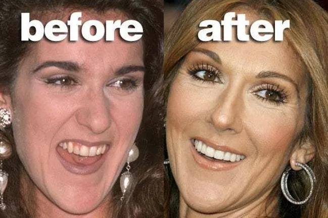 Πριν και μετά φωτογραφία της Celine Dion που δείχνει την αλλαγή στο χαμόγελο και τα δόντια της.
