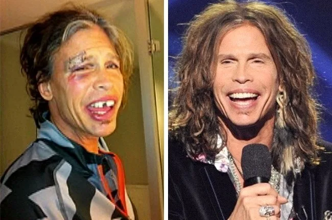 Κολάζ με δύο φωτογραφίες του Steven Tyler, μία με τραύματα στο πρόσωπο και μία χαμογελαστό στη σκηνή.