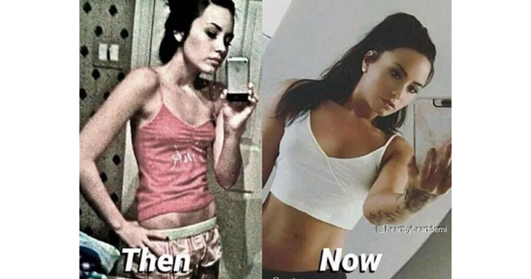 Κολάζ φωτογραφιών της Demi Lovato με το πριν και το μετά της διατροφικής της διαταραχής.