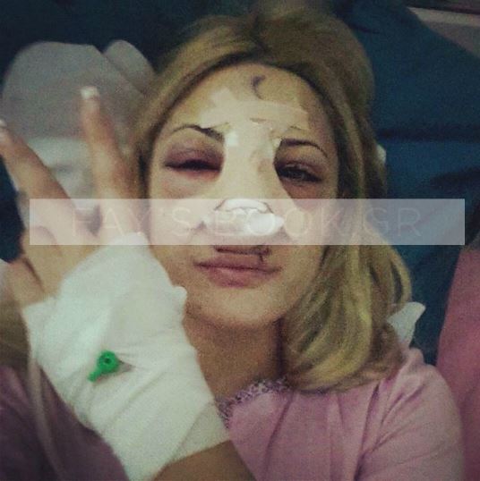 Η Αλεξάνδρα Παναγιώταρου στο κρεβάτι του νοσοκομείου μετά από πλαστική επέμβαση στη μύτη.