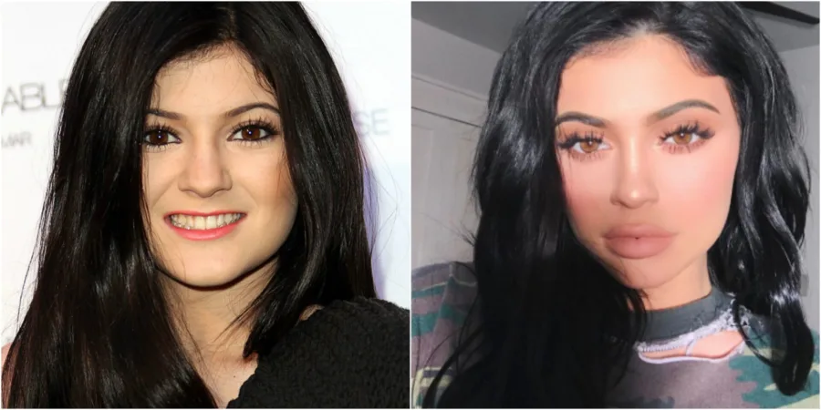 celebrities που έχουν μετανιώσει τις πλαστικές επεμβάσεις τους