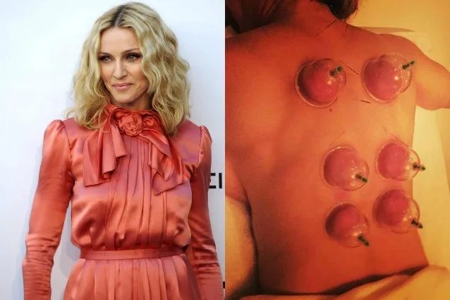 celebrities με τις πιο περίεργες "θεραπείες" ομορφιάς