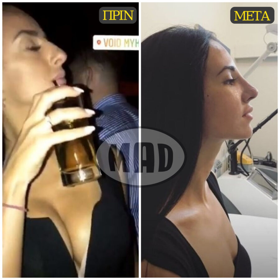 Η Τζούλια Καραγιάννη πριν και μετά την πλαστική επέμβαση στη μύτη.