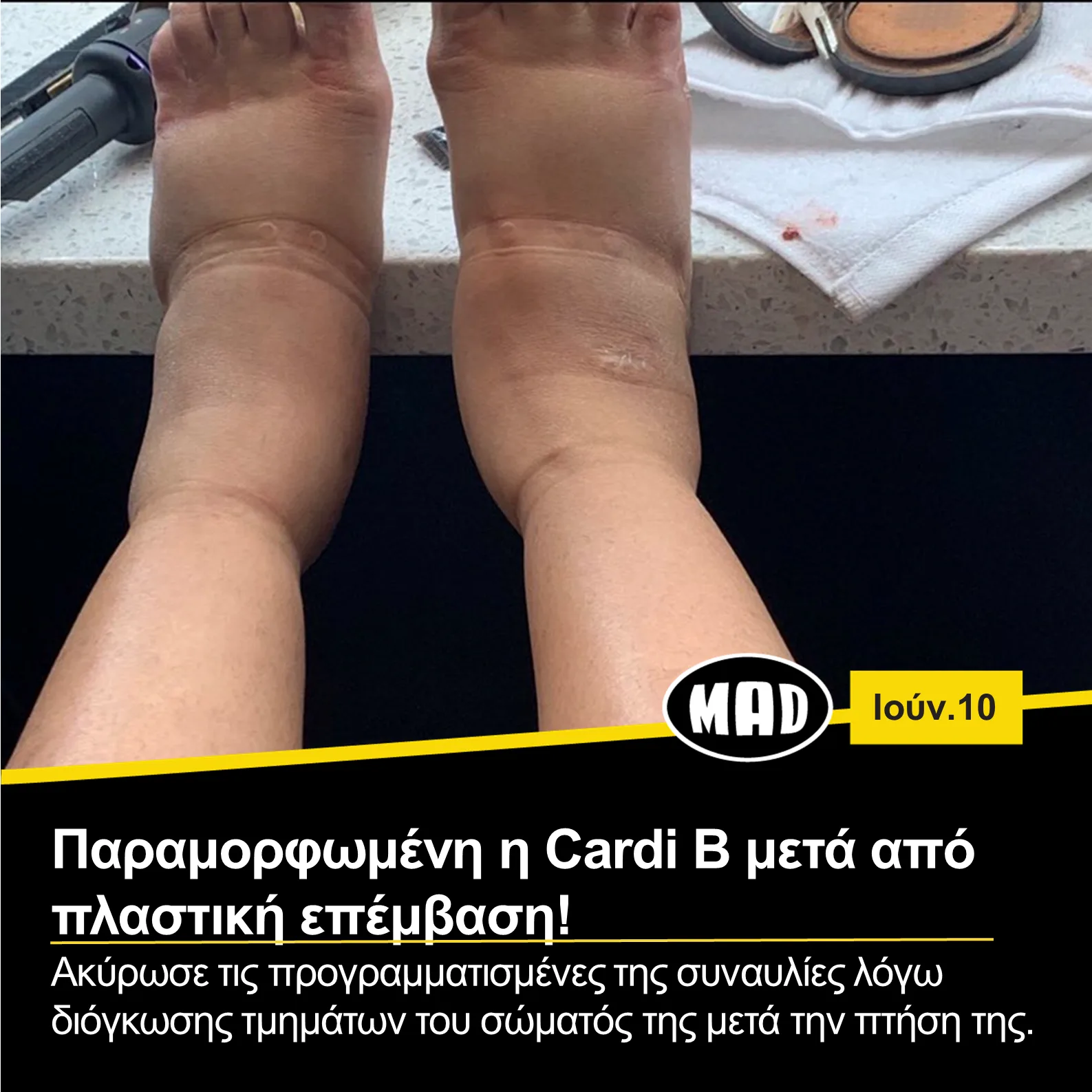 Κοντινό πλάνο στα πρησμένα πόδια της Cardi B.